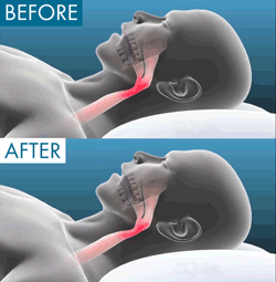 Anti Snore Mouth-Piece